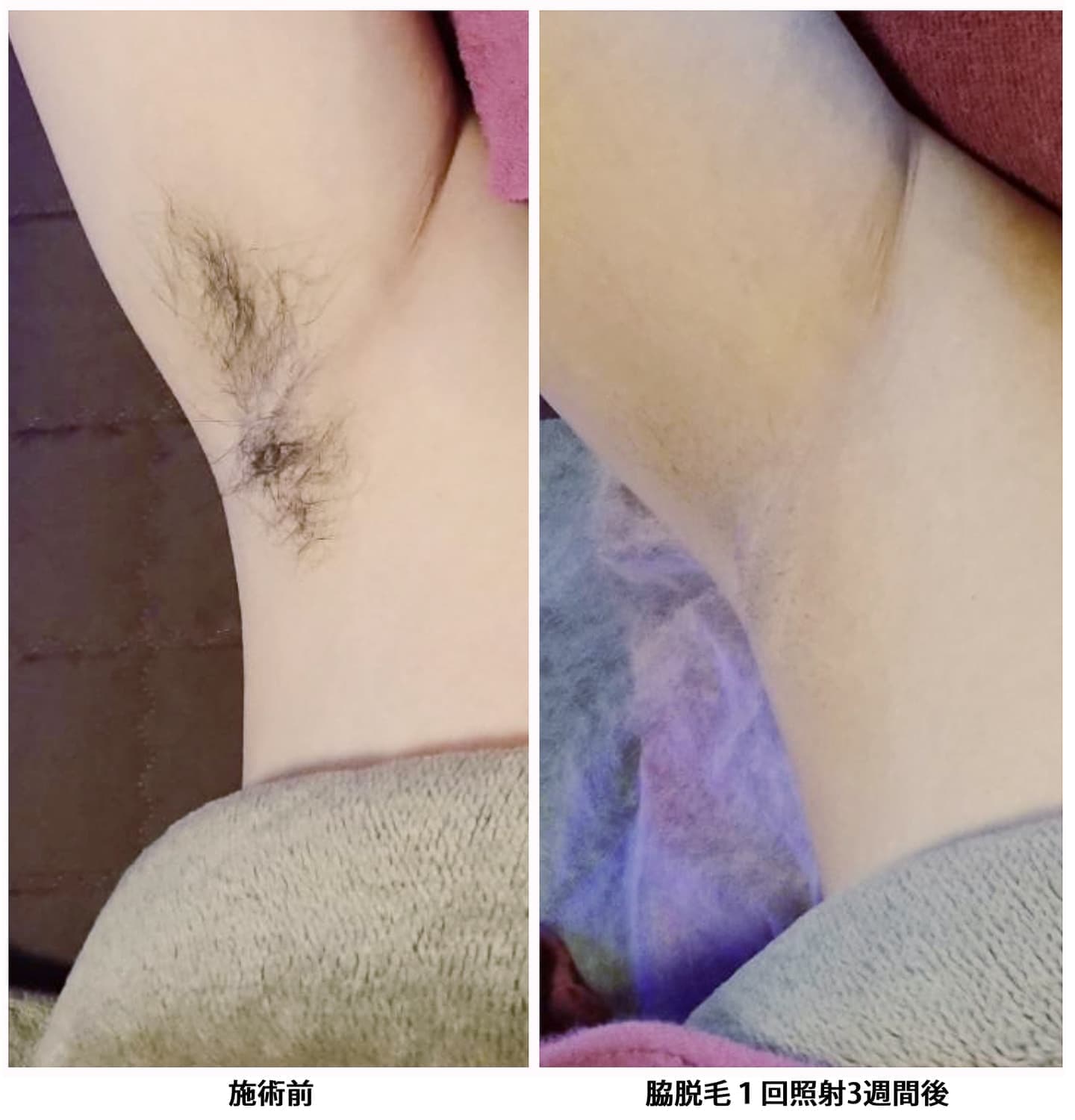 脱毛施術事例
